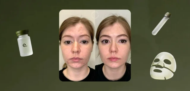 Кейс estee clinic: лечение акне