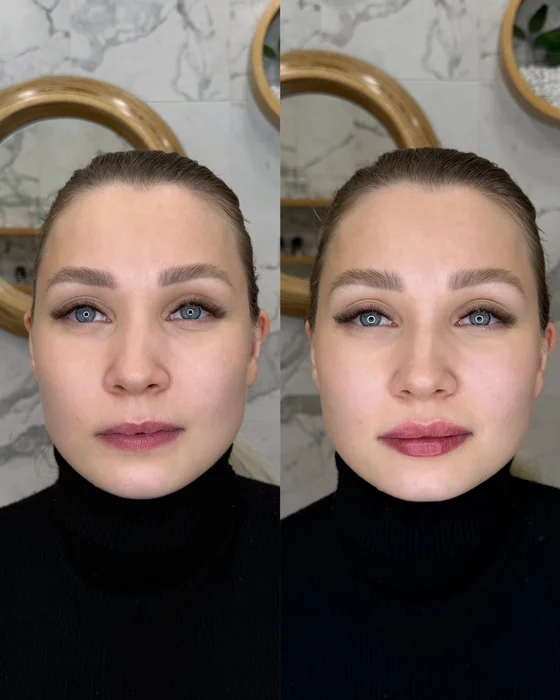 Контурная пластика губ