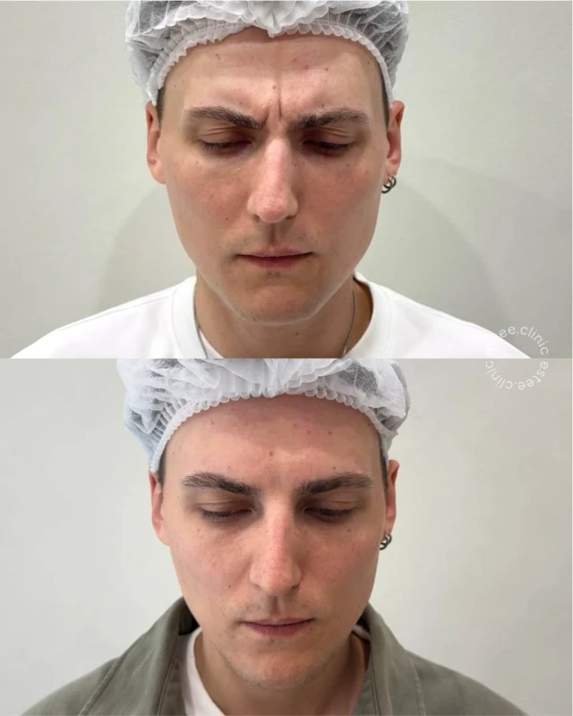 Ботулинотерапия