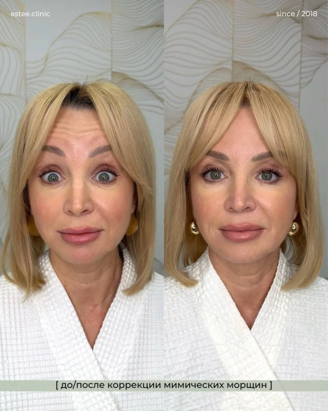 Ботулинотерапия