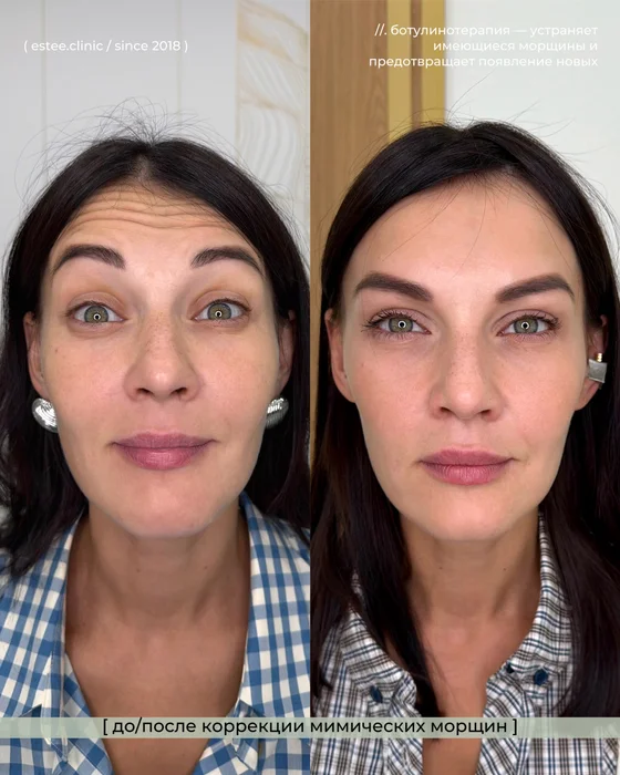 Ботулинотерапия 