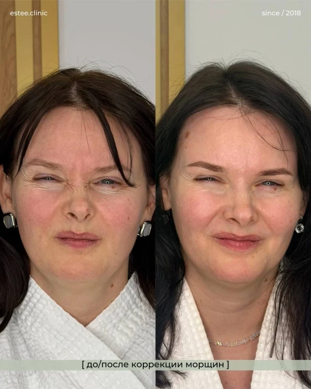 Ботулинотерапия